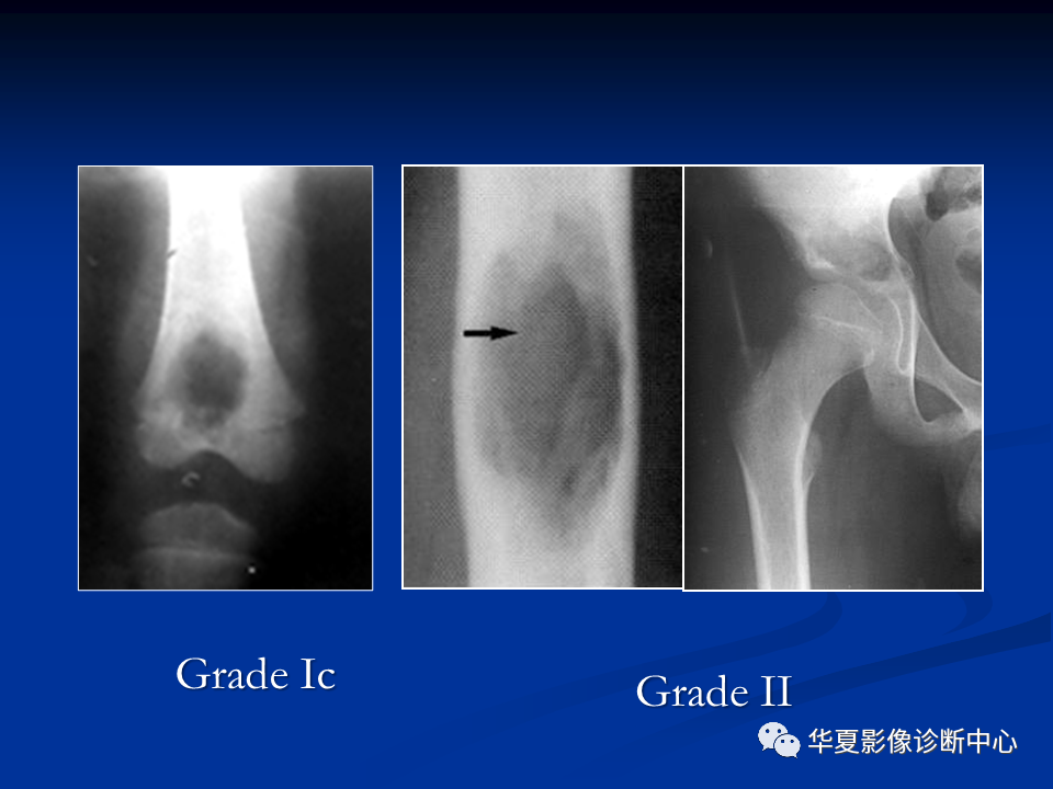 影像PPT - 【PPT】骨肿瘤影像诊断思路-51