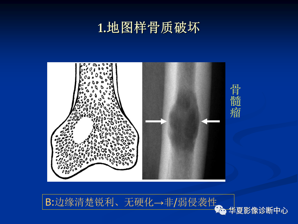 影像PPT - 【PPT】骨肿瘤影像诊断思路-55