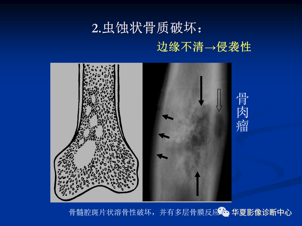 影像PPT - 【PPT】骨肿瘤影像诊断思路-57