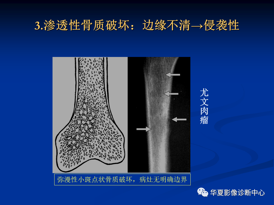 影像PPT - 【PPT】骨肿瘤影像诊断思路-58