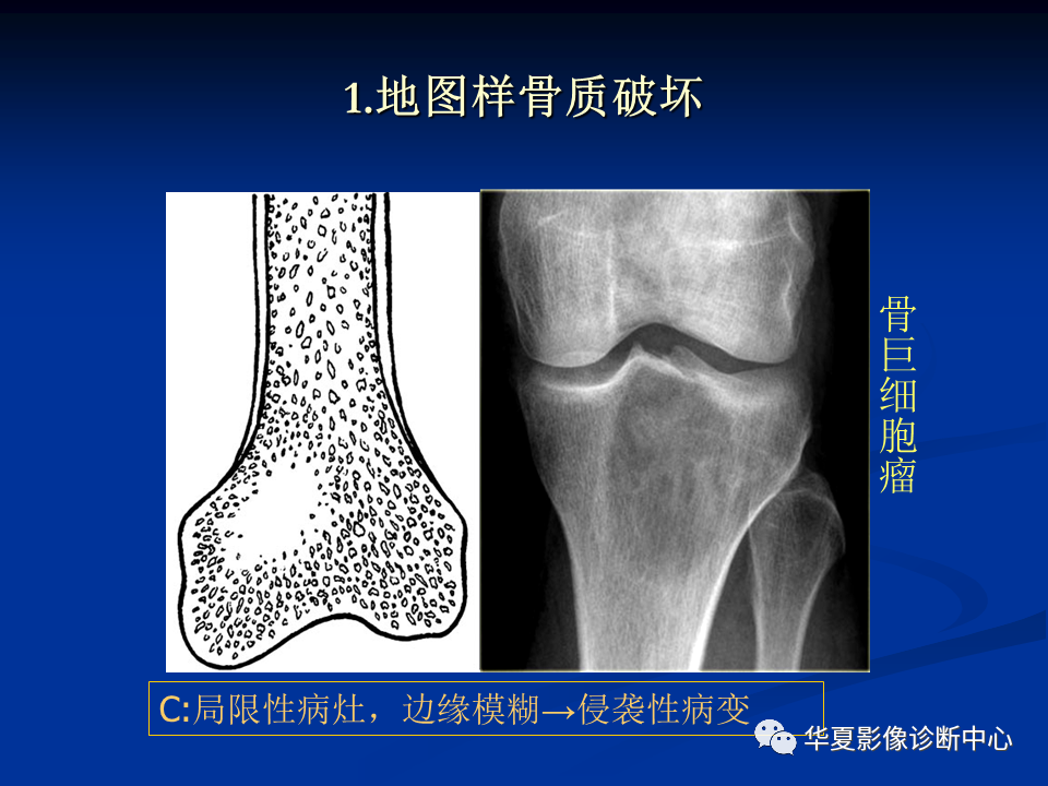 影像PPT - 【PPT】骨肿瘤影像诊断思路-56