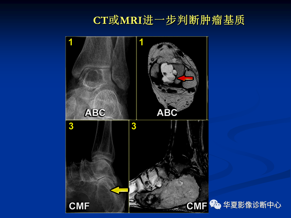 影像PPT - 【PPT】骨肿瘤影像诊断思路-64