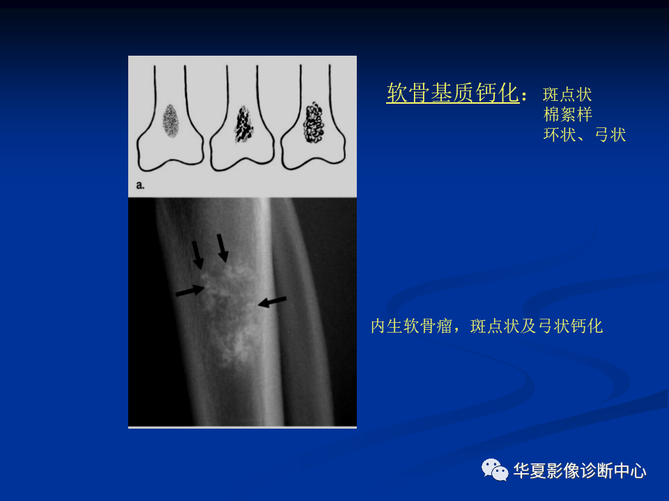 影像PPT - 【PPT】骨肿瘤影像诊断思路-66