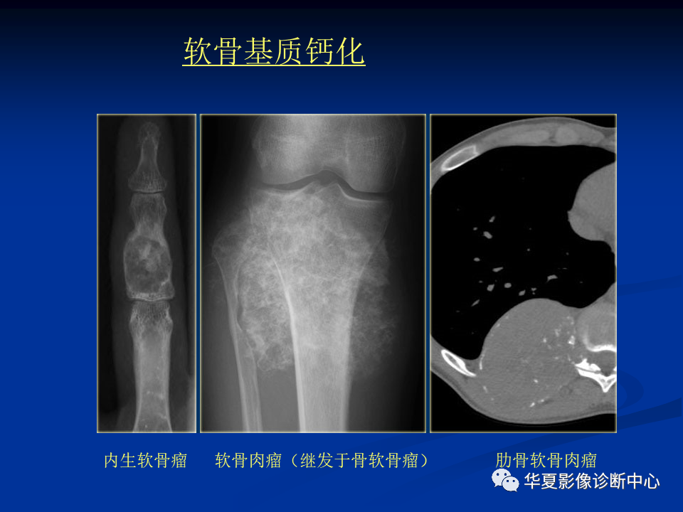 影像PPT - 【PPT】骨肿瘤影像诊断思路-67