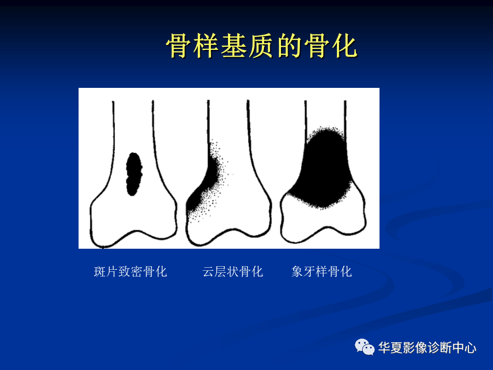 影像PPT - 【PPT】骨肿瘤影像诊断思路-68