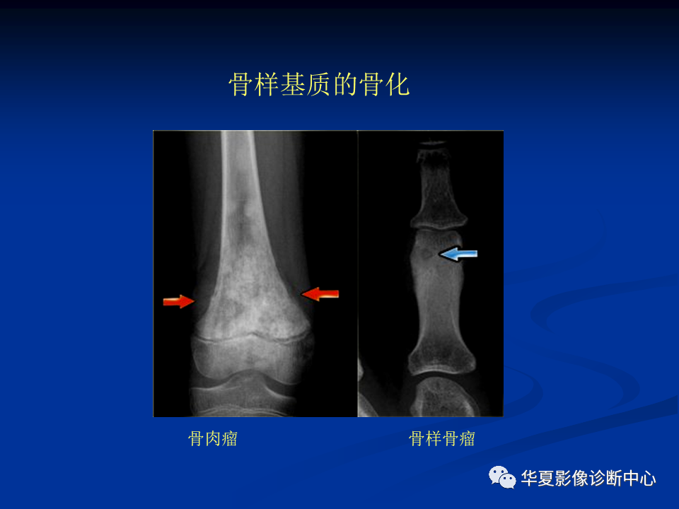 影像PPT - 【PPT】骨肿瘤影像诊断思路-69