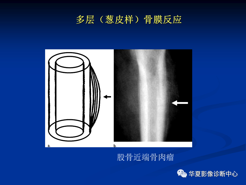 影像PPT - 【PPT】骨肿瘤影像诊断思路-72