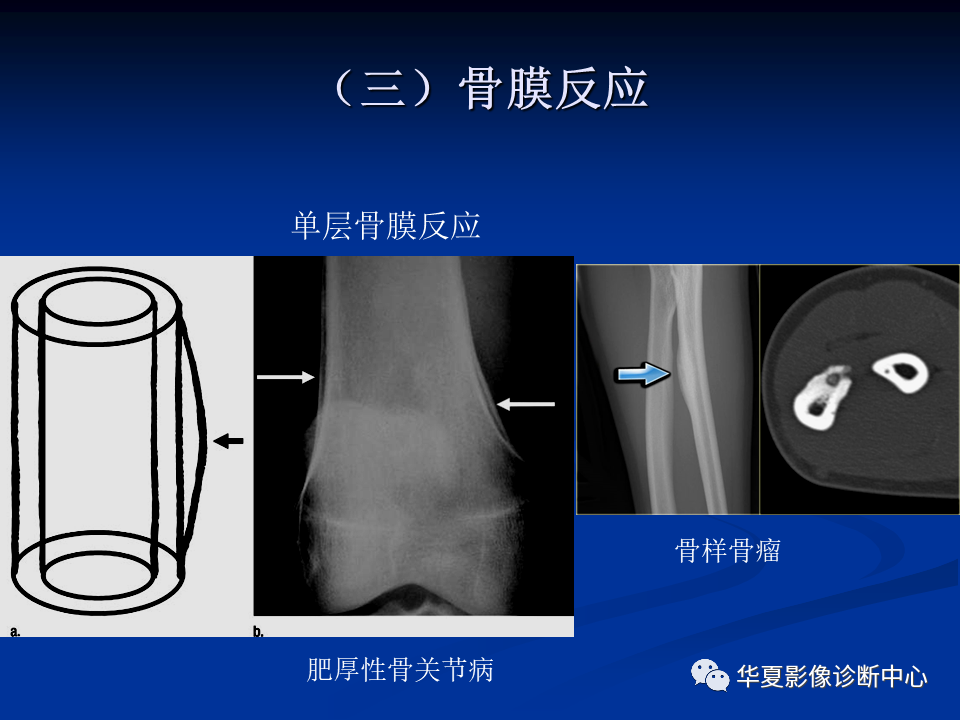 影像PPT - 【PPT】骨肿瘤影像诊断思路-71
