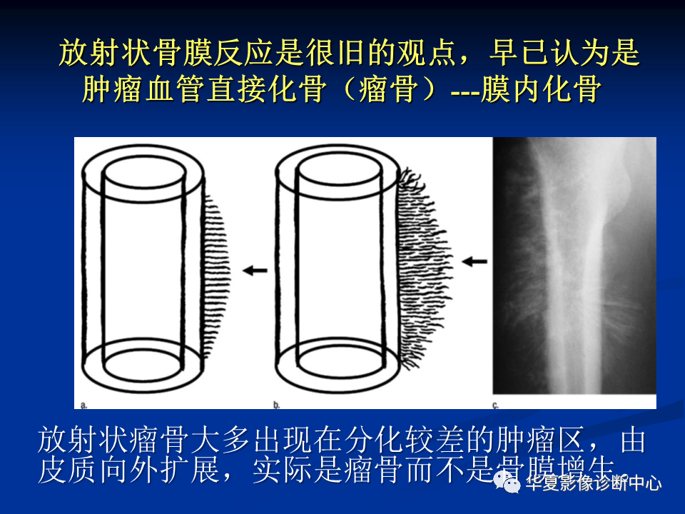 影像PPT - 【PPT】骨肿瘤影像诊断思路-74