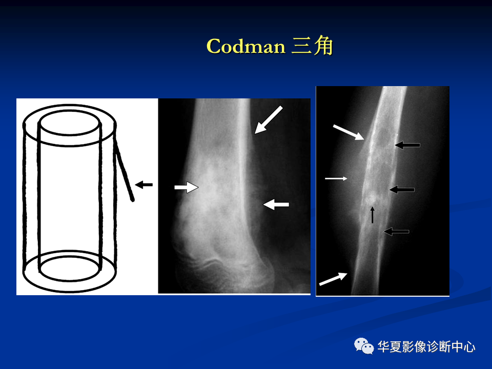 影像PPT - 【PPT】骨肿瘤影像诊断思路-73