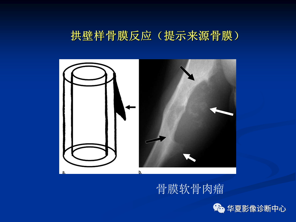影像PPT - 【PPT】骨肿瘤影像诊断思路-75