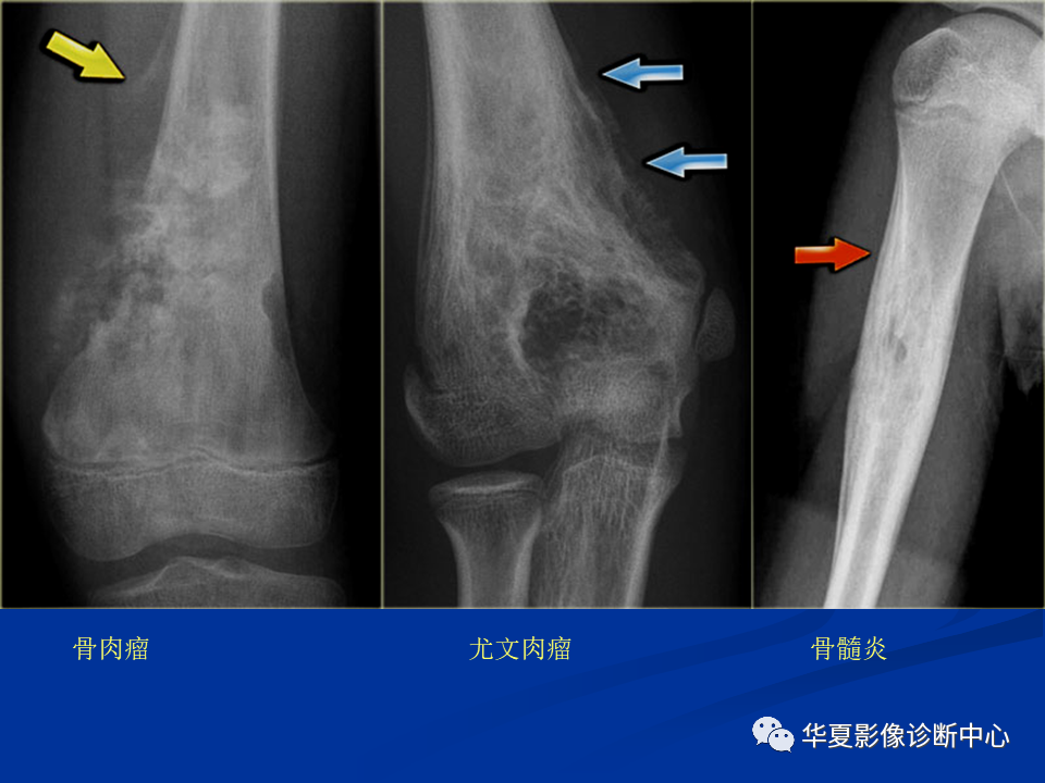影像PPT - 【PPT】骨肿瘤影像诊断思路-76