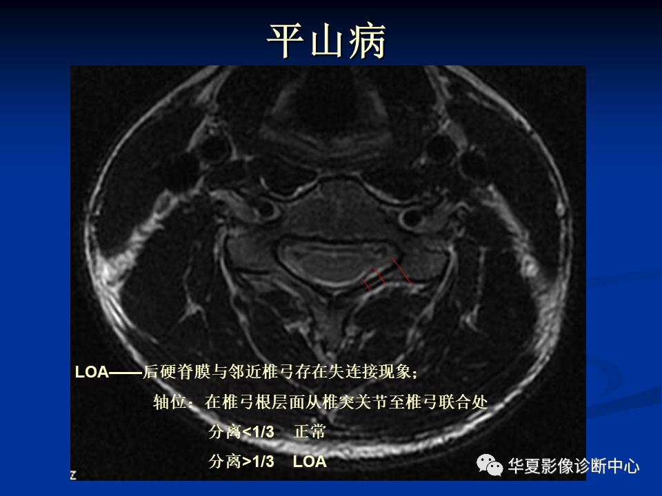 影像PPT - 【PPT】骨肿瘤影像诊断思路-80