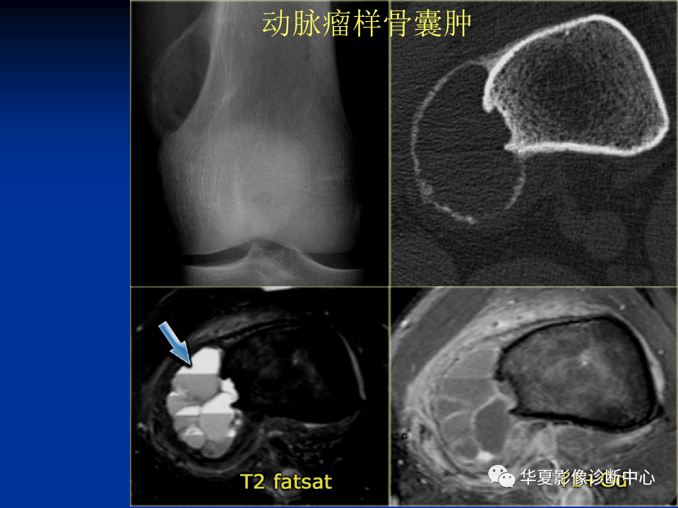 影像PPT - 【PPT】骨肿瘤影像诊断思路-136
