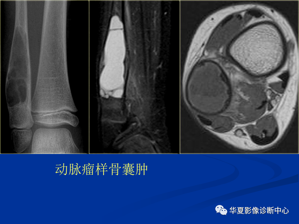影像PPT - 【PPT】骨肿瘤影像诊断思路-135