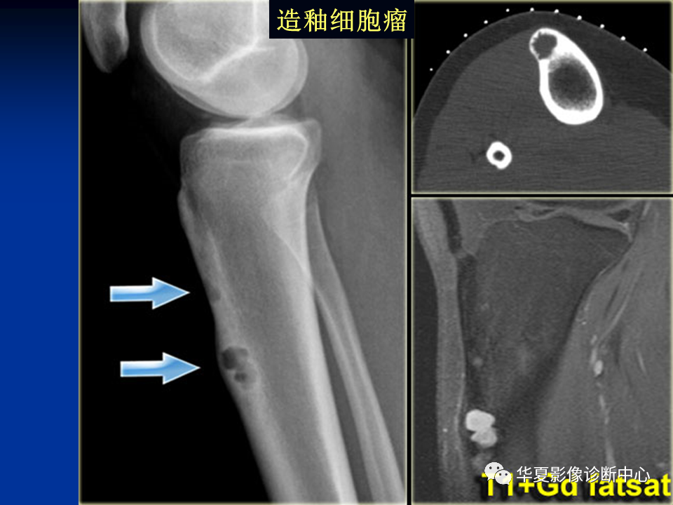 影像PPT - 【PPT】骨肿瘤影像诊断思路-138