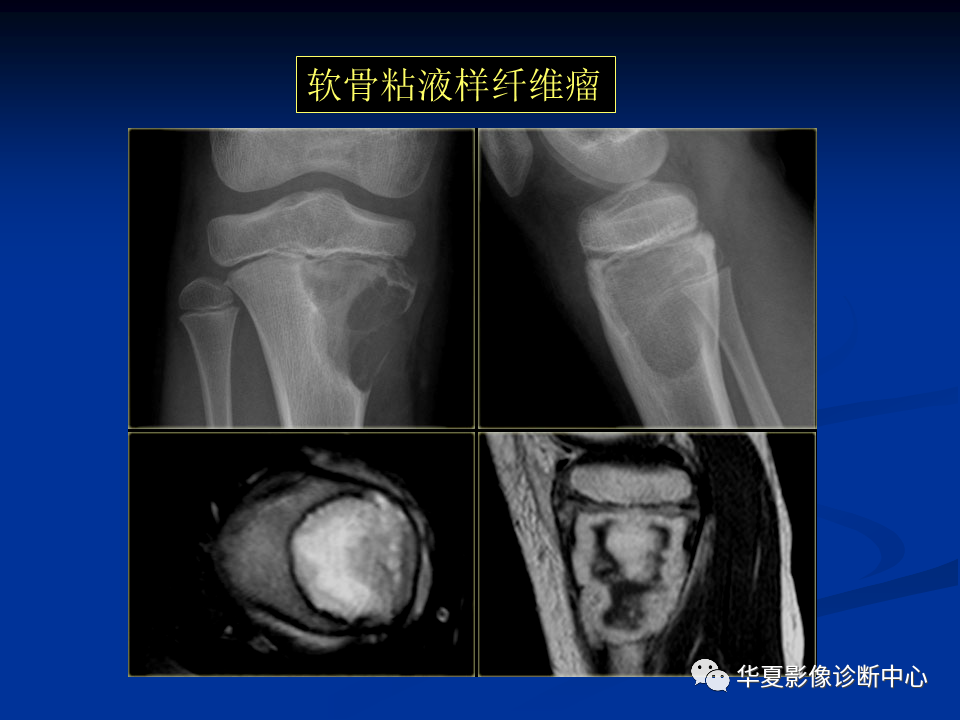 影像PPT - 【PPT】骨肿瘤影像诊断思路-143