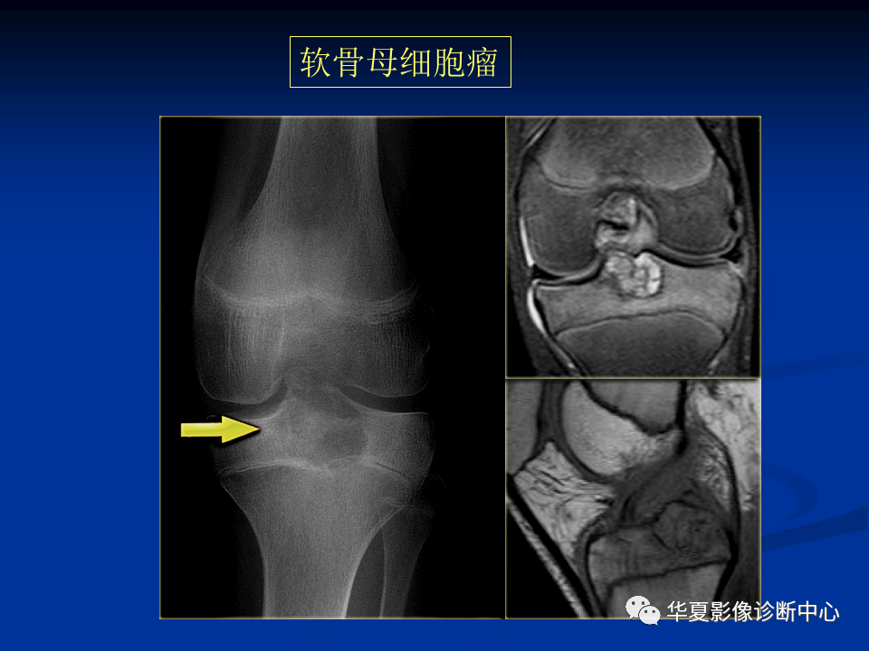 影像PPT - 【PPT】骨肿瘤影像诊断思路-140