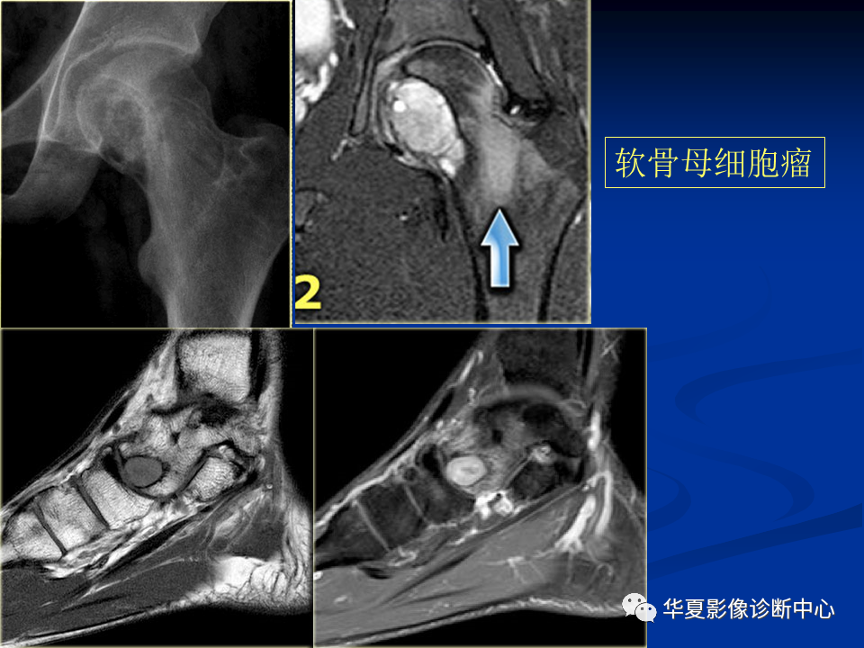 影像PPT - 【PPT】骨肿瘤影像诊断思路-141