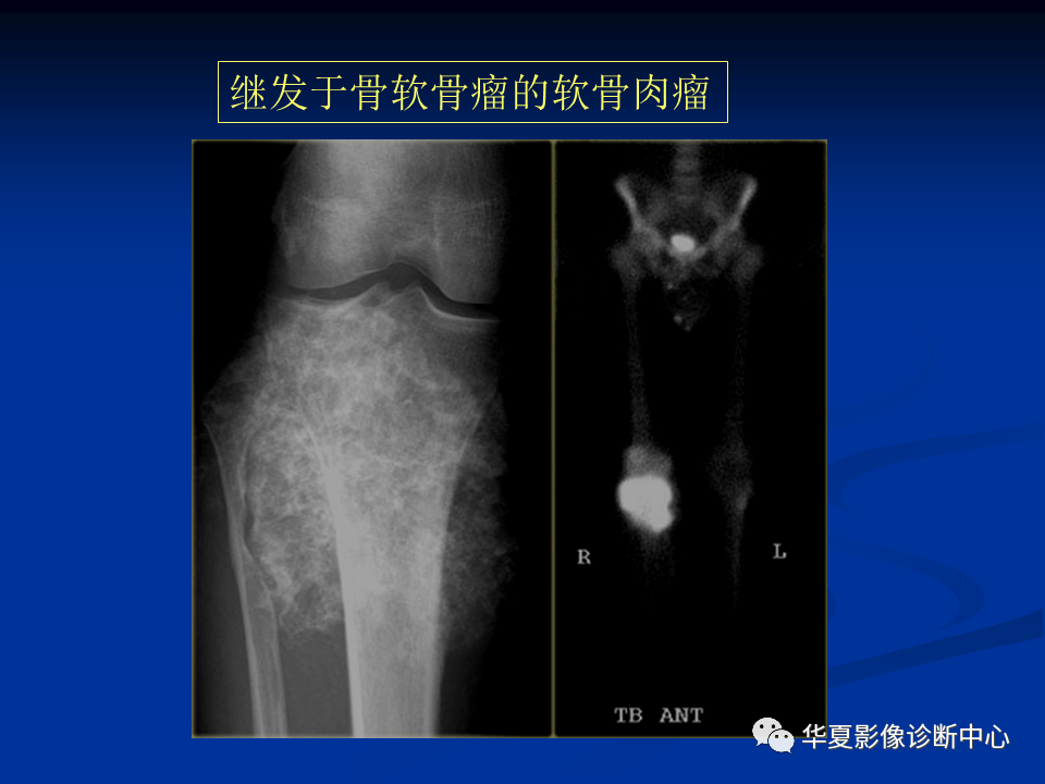 影像PPT - 【PPT】骨肿瘤影像诊断思路-148