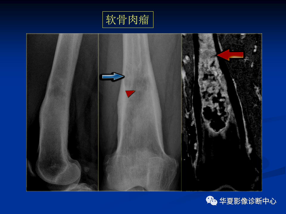 影像PPT - 【PPT】骨肿瘤影像诊断思路-147