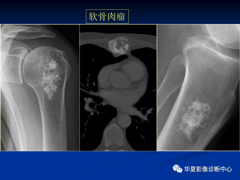 影像PPT - 【PPT】骨肿瘤影像诊断思路-146