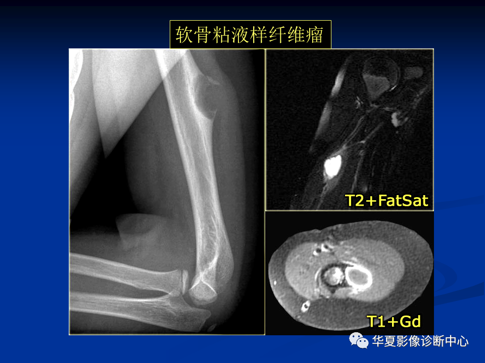 影像PPT - 【PPT】骨肿瘤影像诊断思路-144