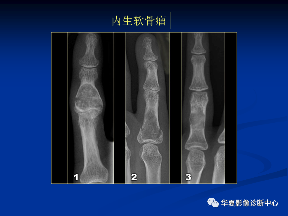 影像PPT - 【PPT】骨肿瘤影像诊断思路-150