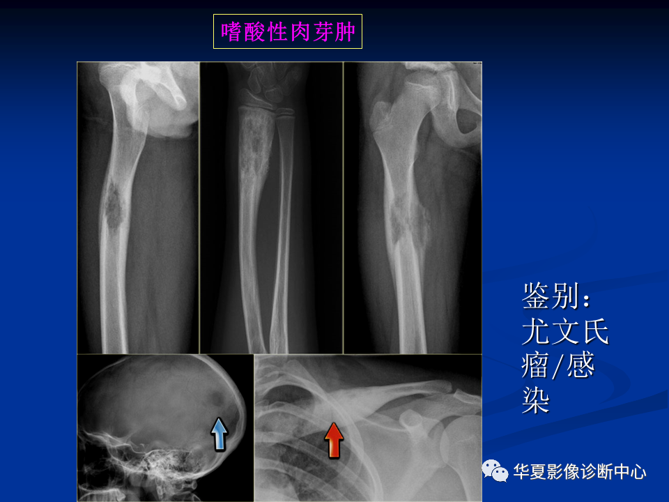 影像PPT - 【PPT】骨肿瘤影像诊断思路-154