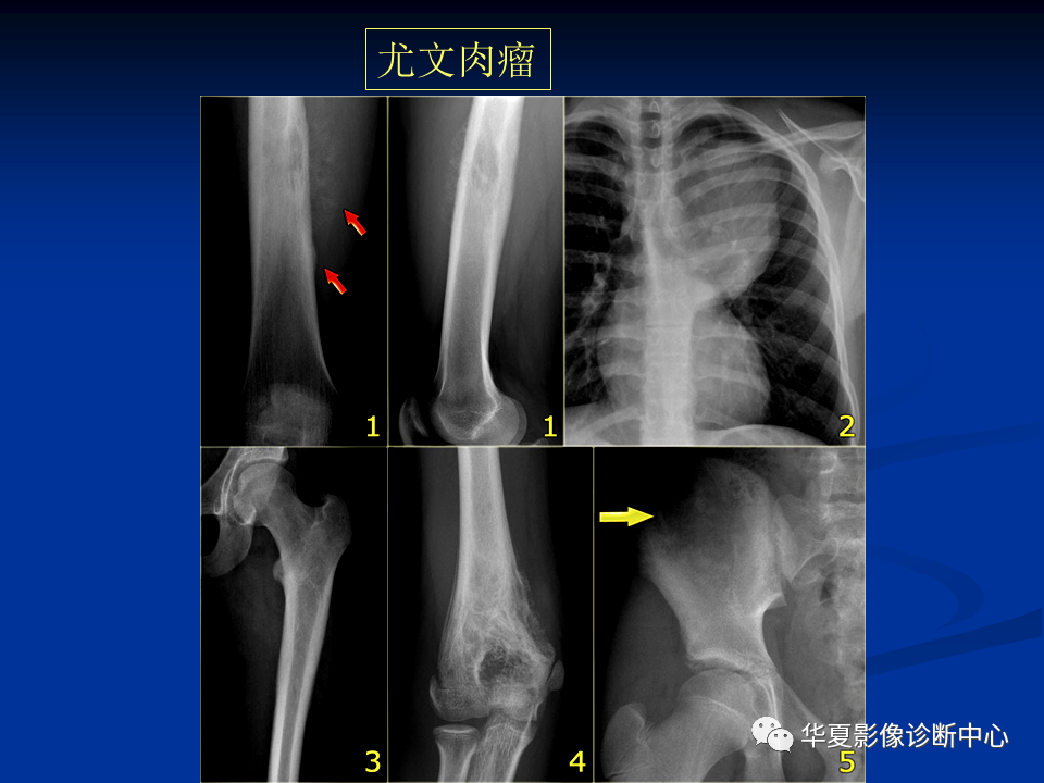 影像PPT - 【PPT】骨肿瘤影像诊断思路-157