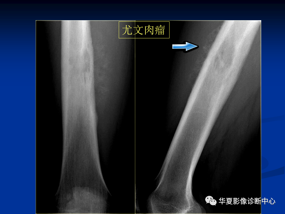 影像PPT - 【PPT】骨肿瘤影像诊断思路-158