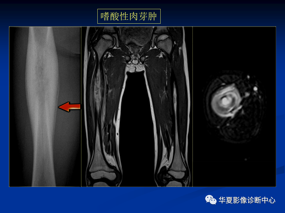 影像PPT - 【PPT】骨肿瘤影像诊断思路-155