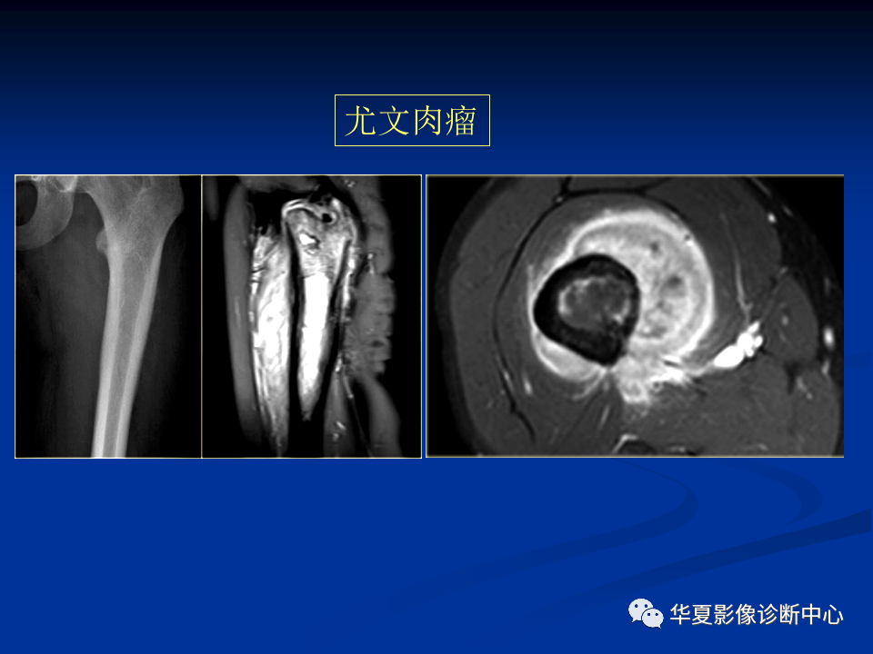 影像PPT - 【PPT】骨肿瘤影像诊断思路-159
