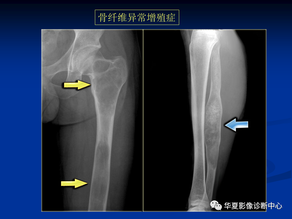 影像PPT - 【PPT】骨肿瘤影像诊断思路-161