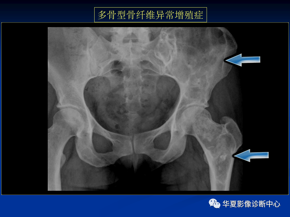 影像PPT - 【PPT】骨肿瘤影像诊断思路-162
