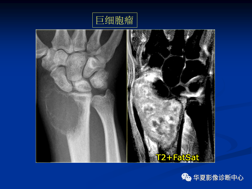 影像PPT - 【PPT】骨肿瘤影像诊断思路-165