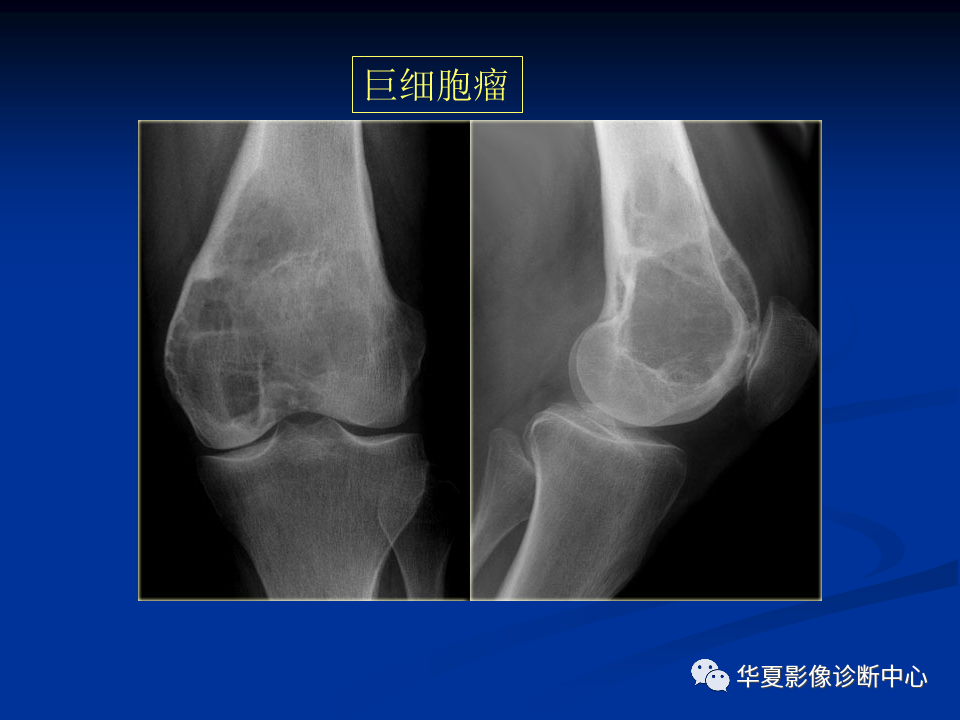影像PPT - 【PPT】骨肿瘤影像诊断思路-164