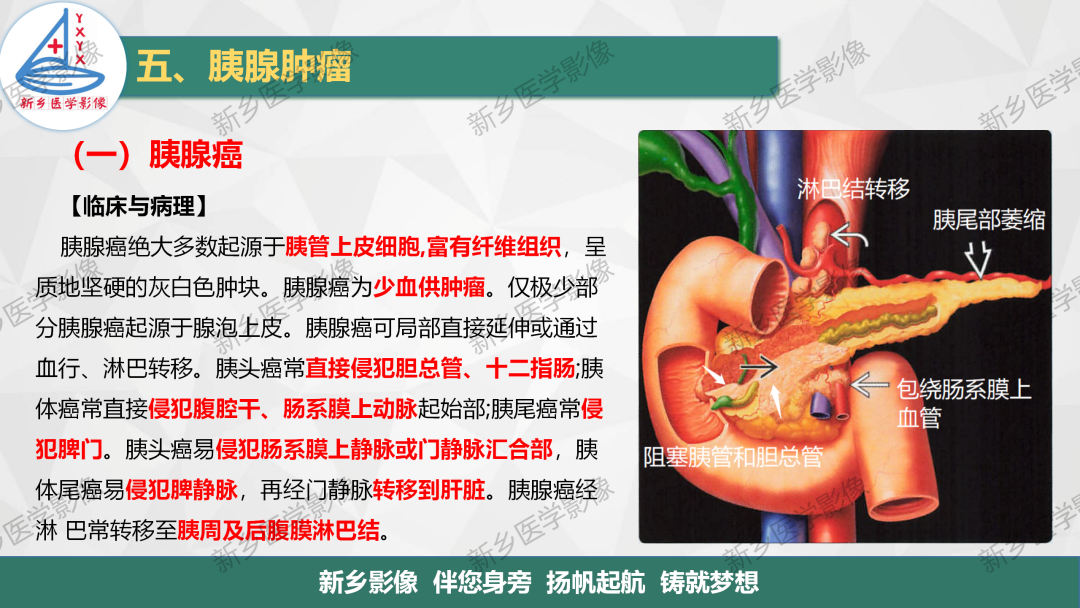 影像PPT - 【PPT】胰腺疾病影像表现-4
