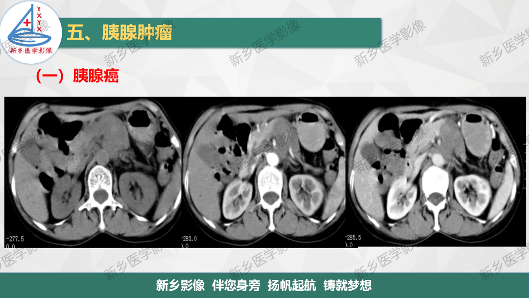 影像PPT - 【PPT】胰腺疾病影像表现-6