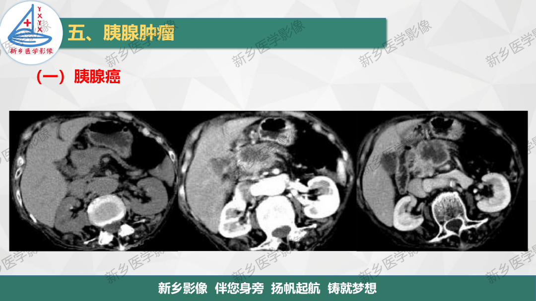 影像PPT - 【PPT】胰腺疾病影像表现-7