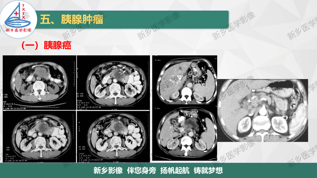 影像PPT - 【PPT】胰腺疾病影像表现-11