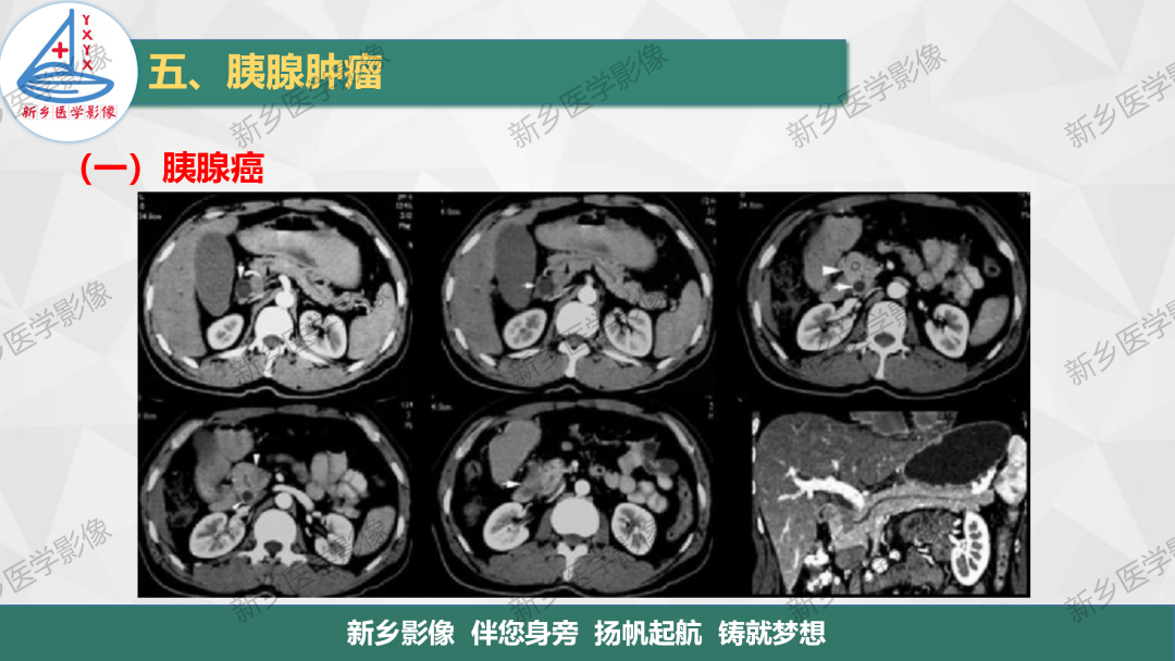 影像PPT - 【PPT】胰腺疾病影像表现-10