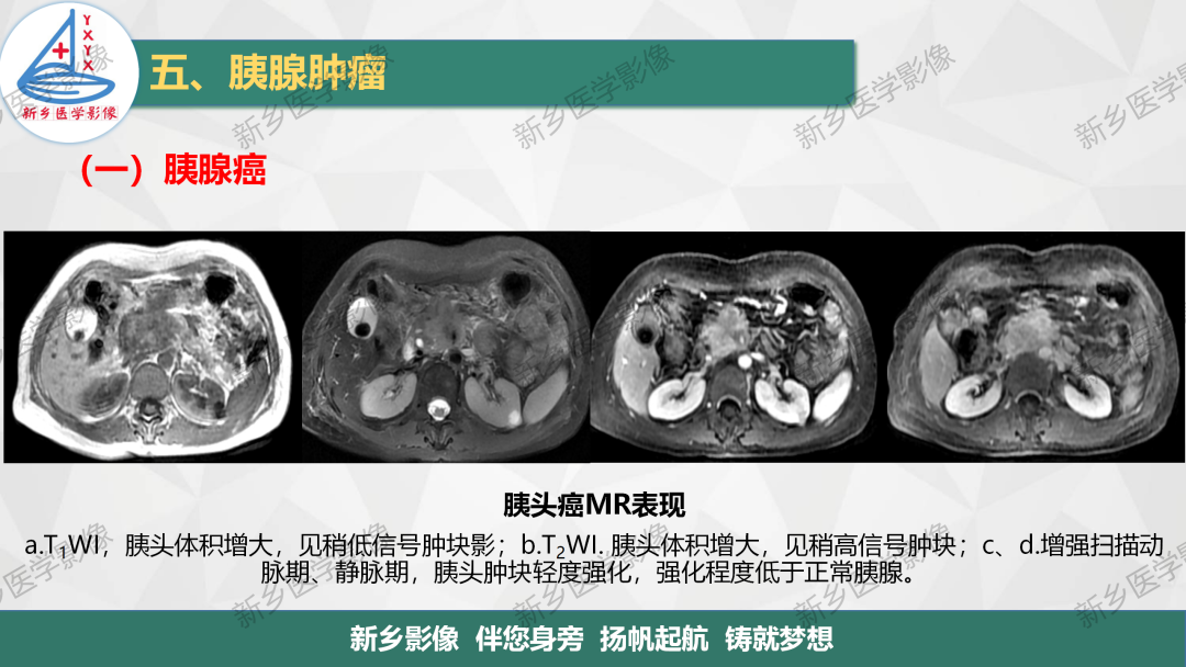影像PPT - 【PPT】胰腺疾病影像表现-13