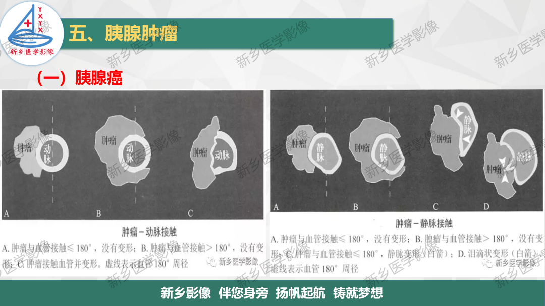 影像PPT - 【PPT】胰腺疾病影像表现-17