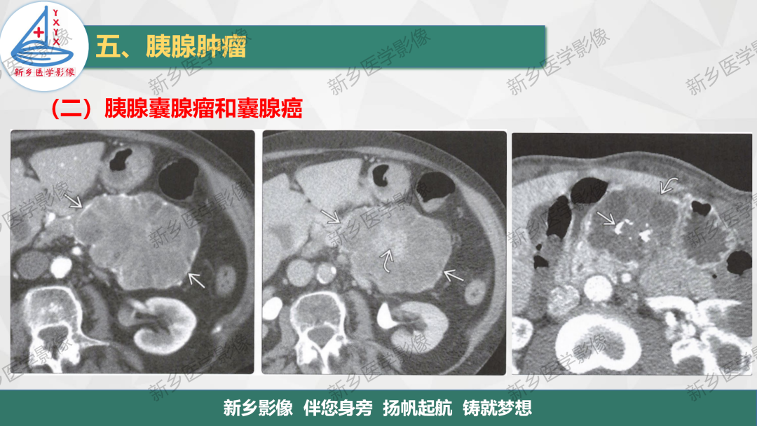 影像PPT - 【PPT】胰腺疾病影像表现-21