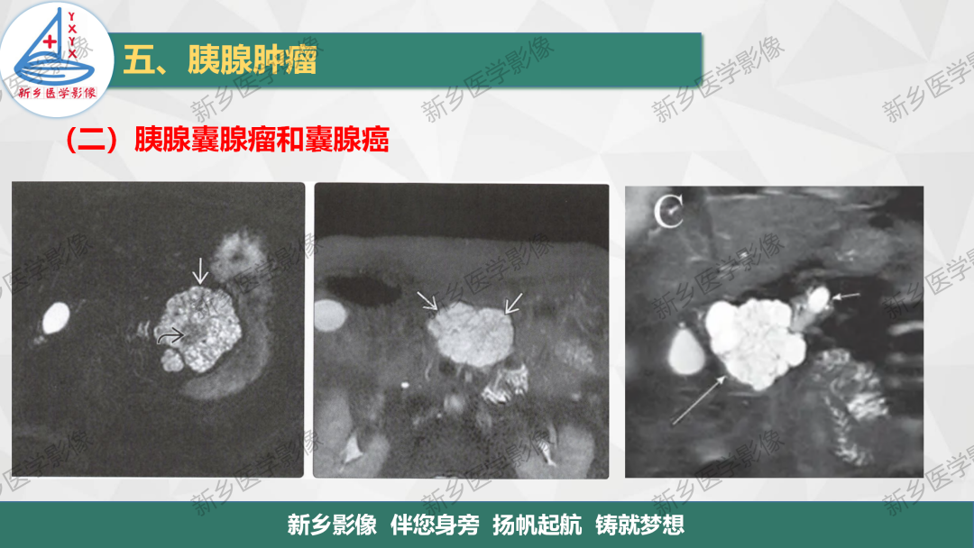 影像PPT - 【PPT】胰腺疾病影像表现-22