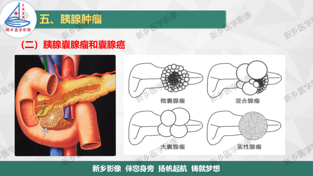 影像PPT - 【PPT】胰腺疾病影像表现-20