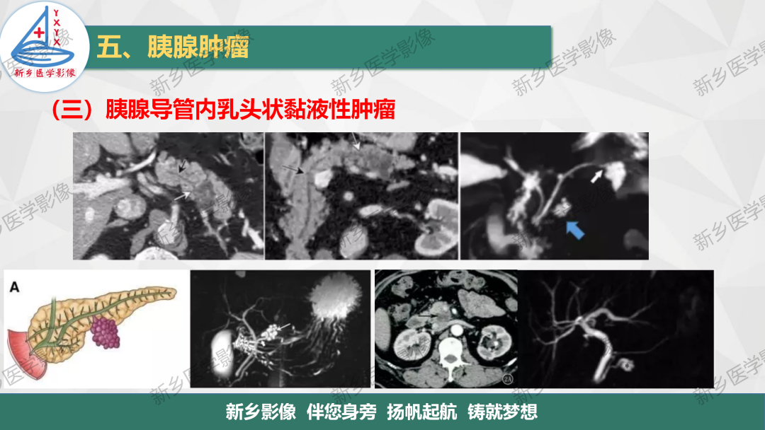影像PPT - 【PPT】胰腺疾病影像表现-28