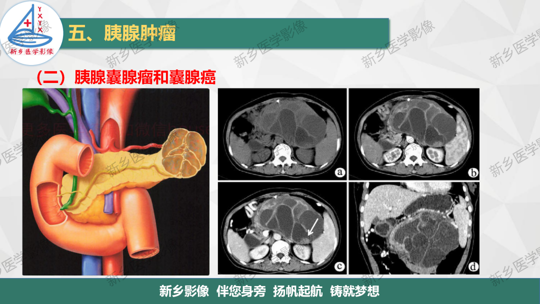 影像PPT - 【PPT】胰腺疾病影像表现-24