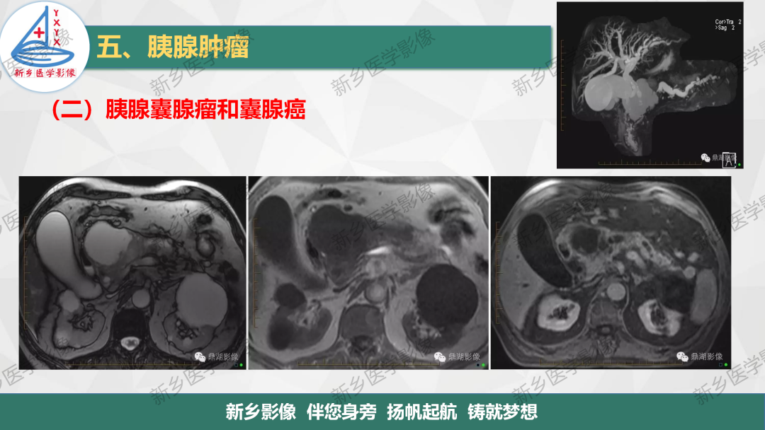 影像PPT - 【PPT】胰腺疾病影像表现-25